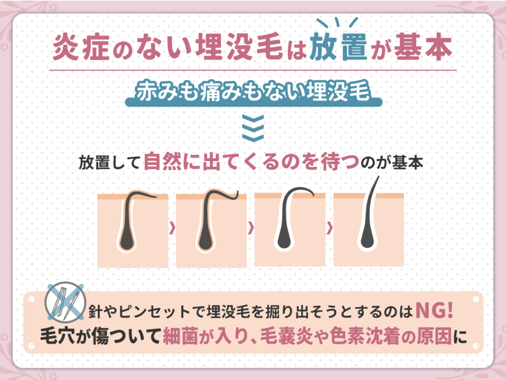 結論|炎症のない埋没毛は放置が基本