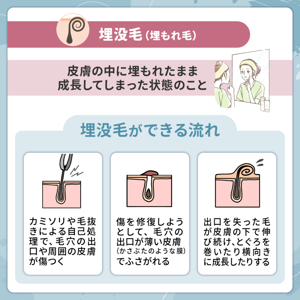 埋没毛(埋もれ毛)は皮膚の中に埋もれたまま成長してしまった状態のこと