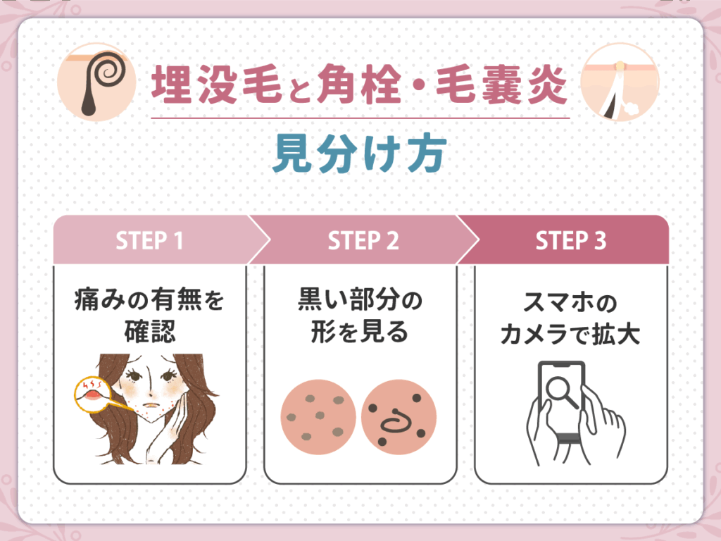 埋没毛と角栓・毛嚢炎の見分け方を初心者向けに解説