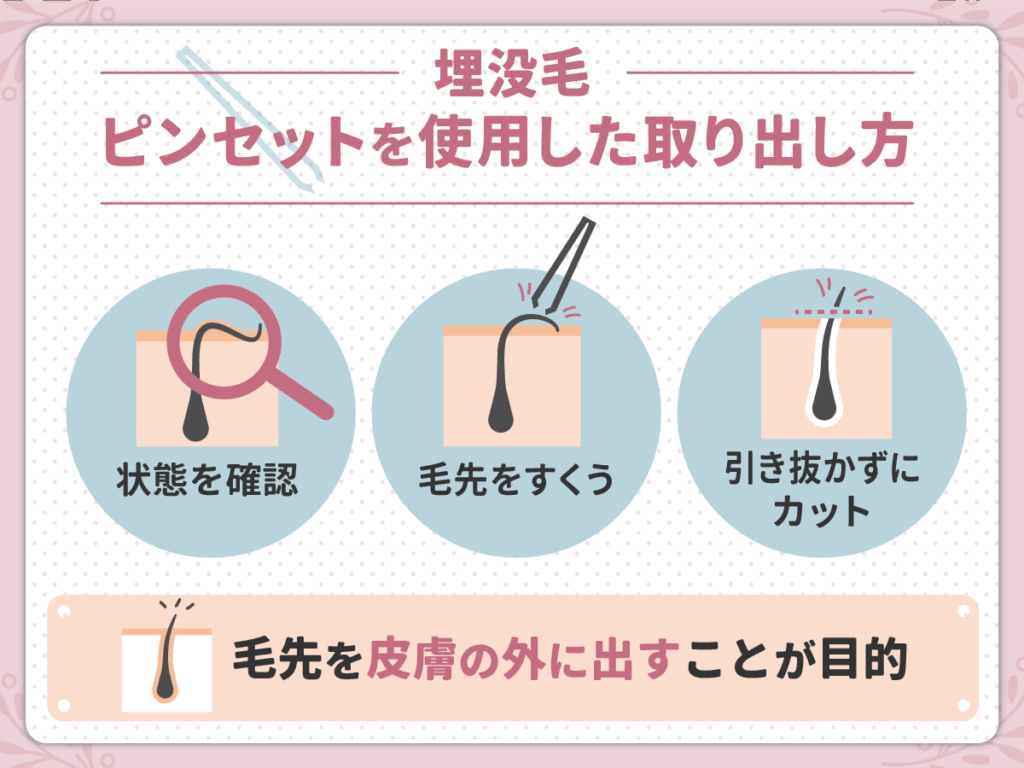 自分でピンセットを使った埋没毛の取り出し方